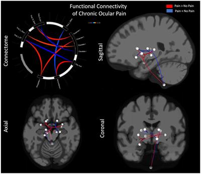 Disentangling the neurological basis of chronic ocular pain using clinical, self-report, and brain imaging data: use of K-means clustering to explore patient phenotypes